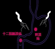 幽门螺杆菌(hp)是什么意思（关于幽门螺杆菌（Hp），这是一篇最全最好的科普）